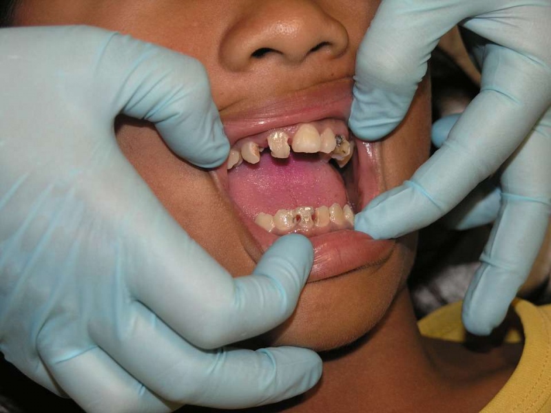 整牙期间主要注意哪些事项整牙需要注意什么